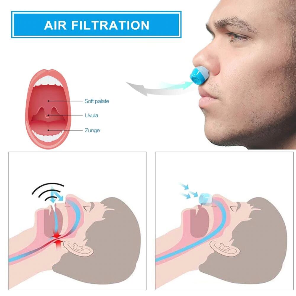 Anti-Snoring Device - Hose-Free & Mask-Free CPAP Micro-Concentrator