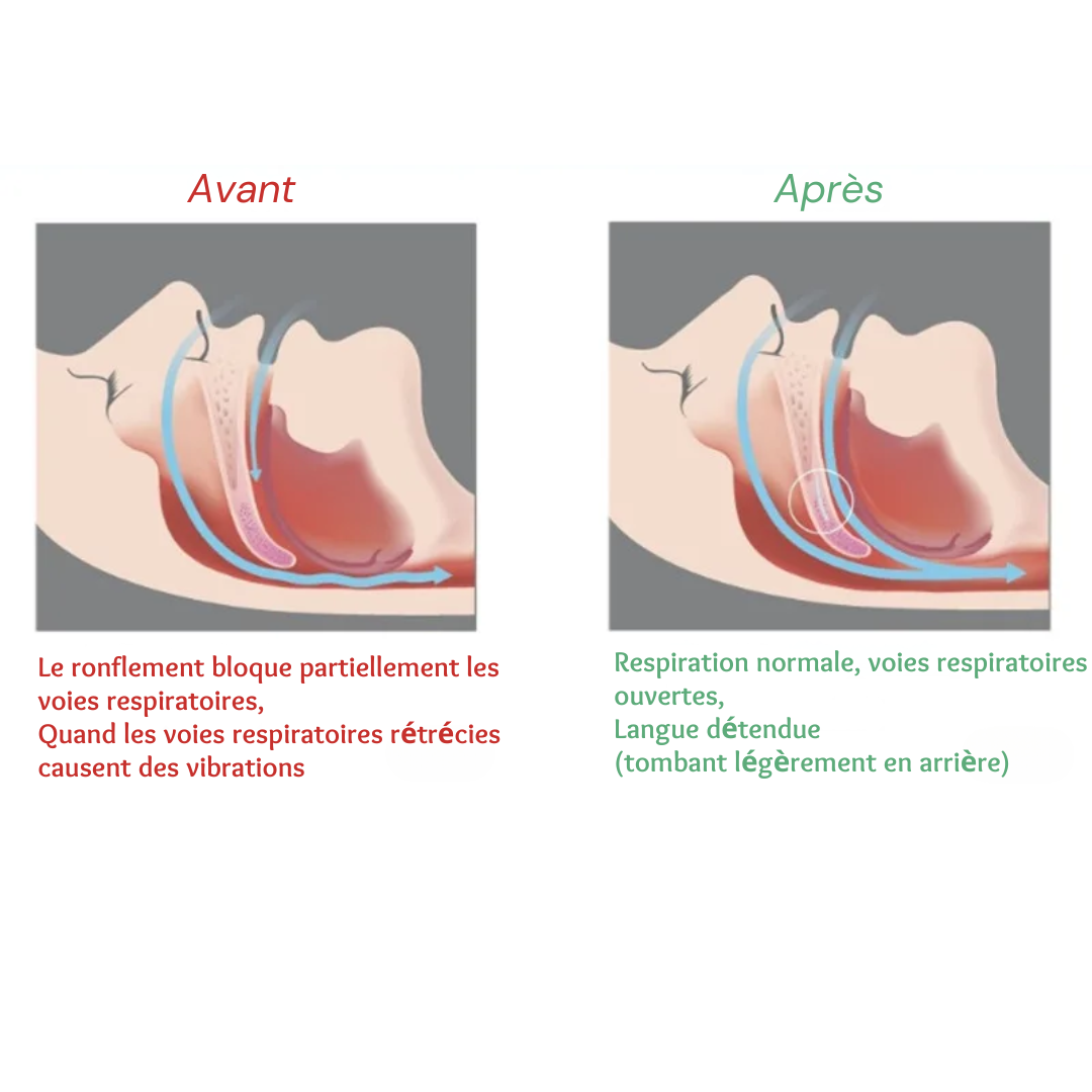 Anti-Snoring Orthosis Mouthpiece: Comfortable Sleep Splint