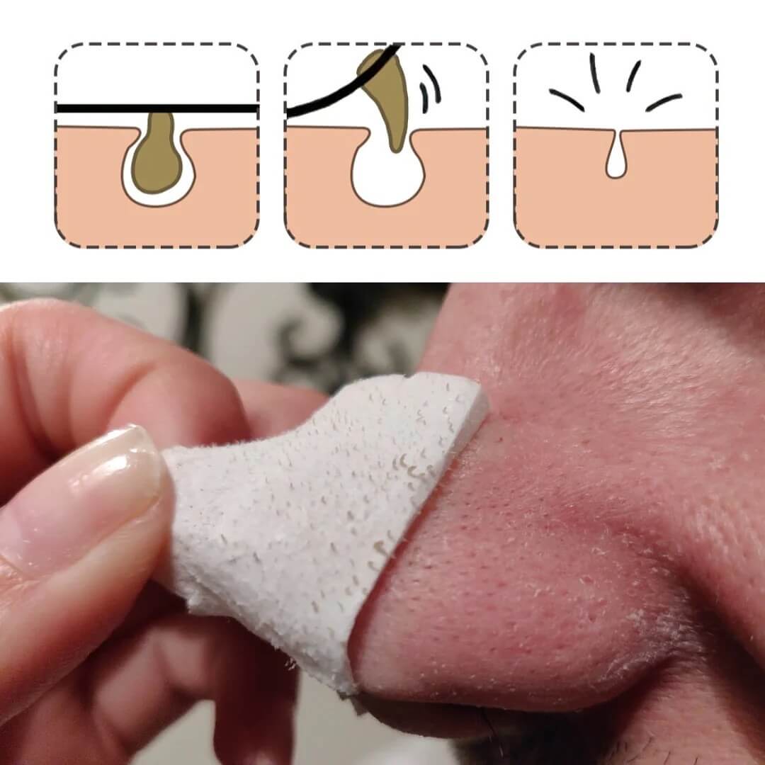 Blackhead Removal Facial Mask
