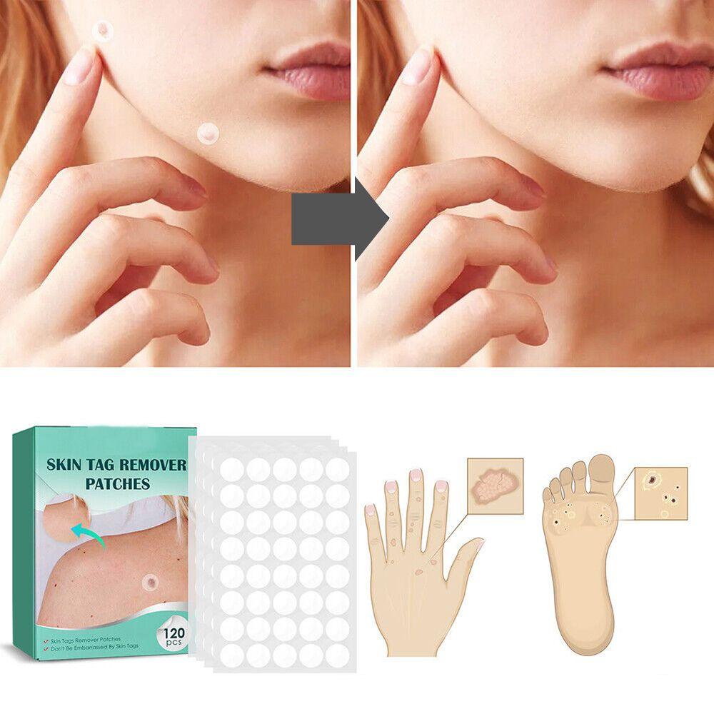Blemish and Wart Removal Patches