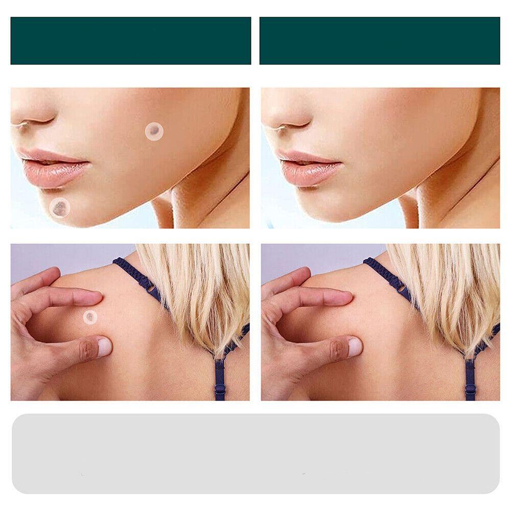 Blemish and Wart Removal Patches