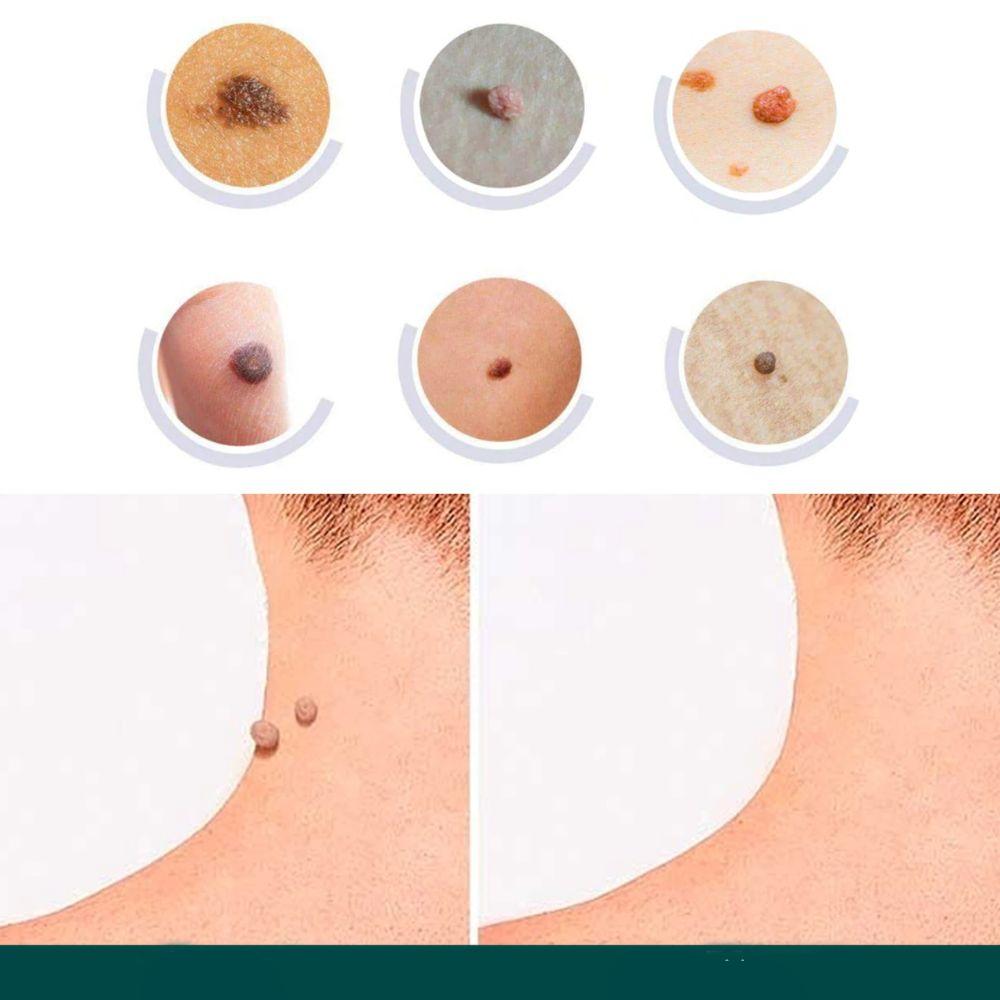 Blemish and Wart Removal Patches