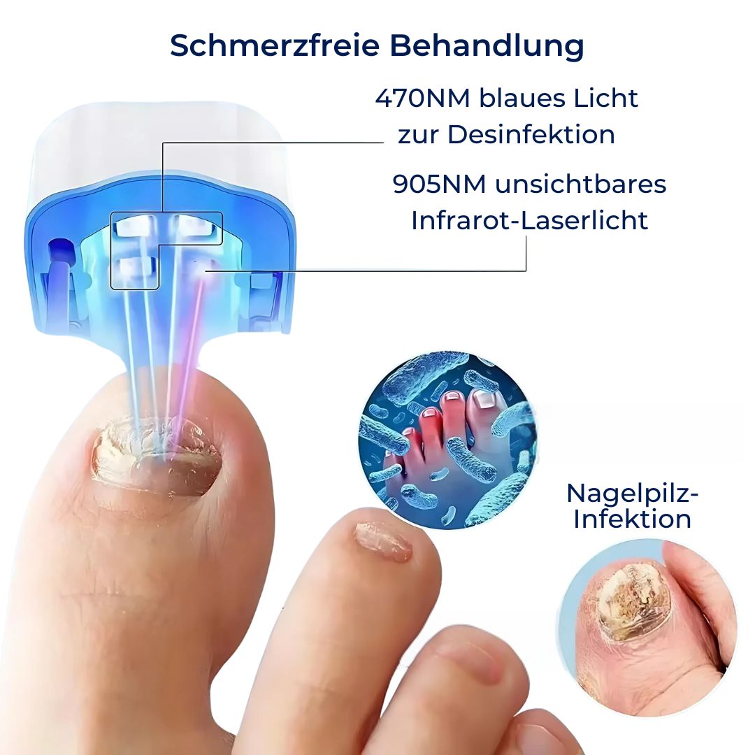 Nail Fungus Laser Device - Painless & Effective