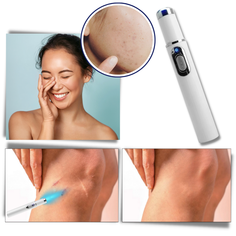 Portable Laser Therapy for a Brighter Complexion