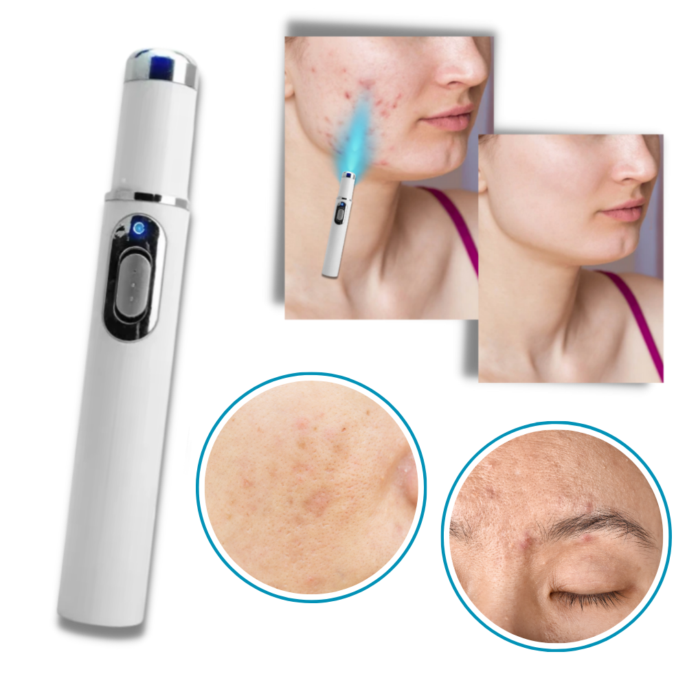 Portable Laser Therapy for a Brighter Complexion